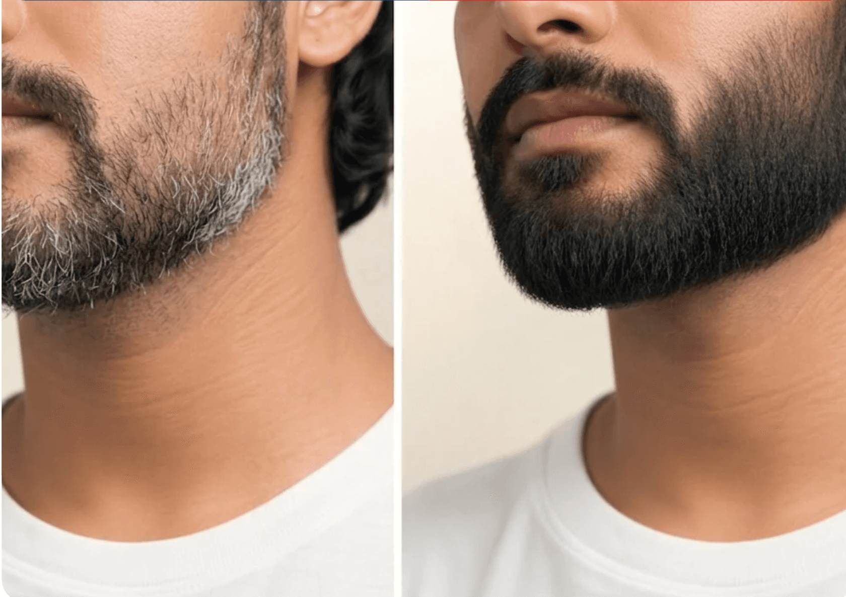 Beard restoration before and after